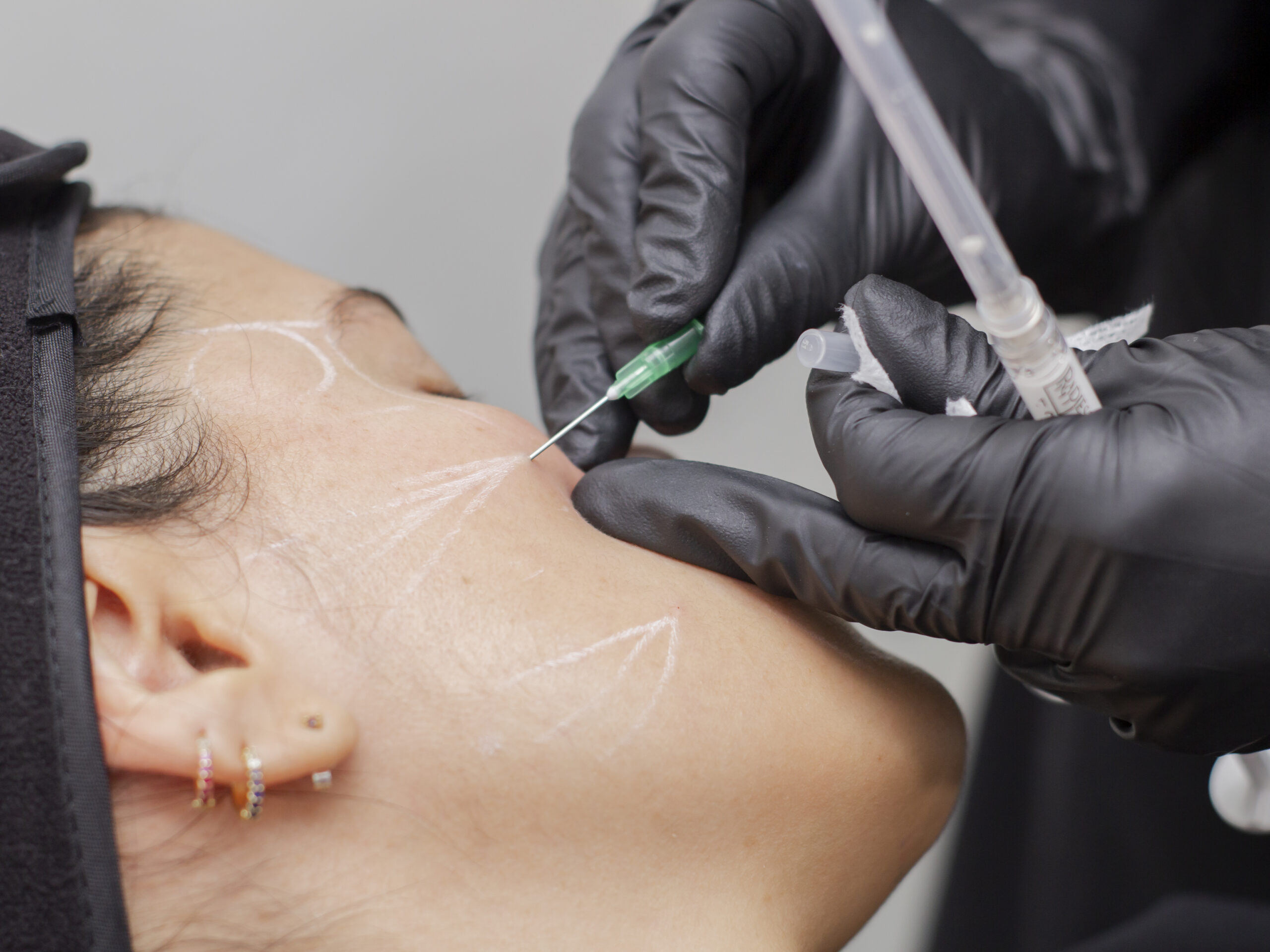 bioestimuladores-de-colageno